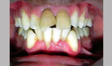 Preventative dentistry treatment in Anand
                        